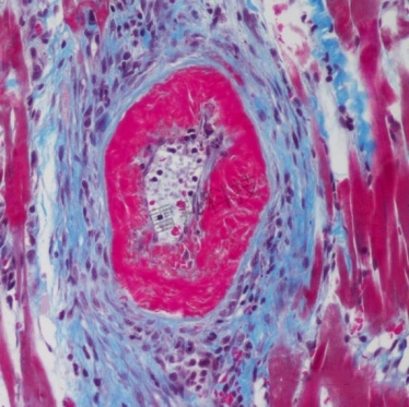 Masson（蓝、绿）